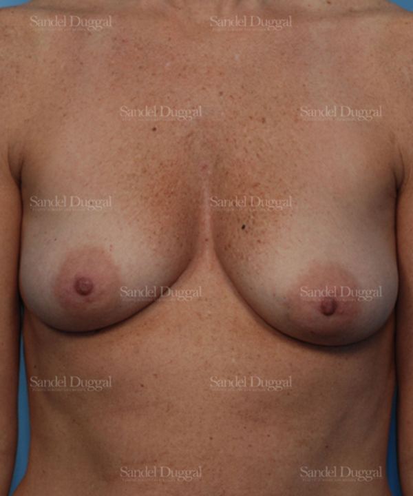 Breast Augmentation with Lift before, case 3435