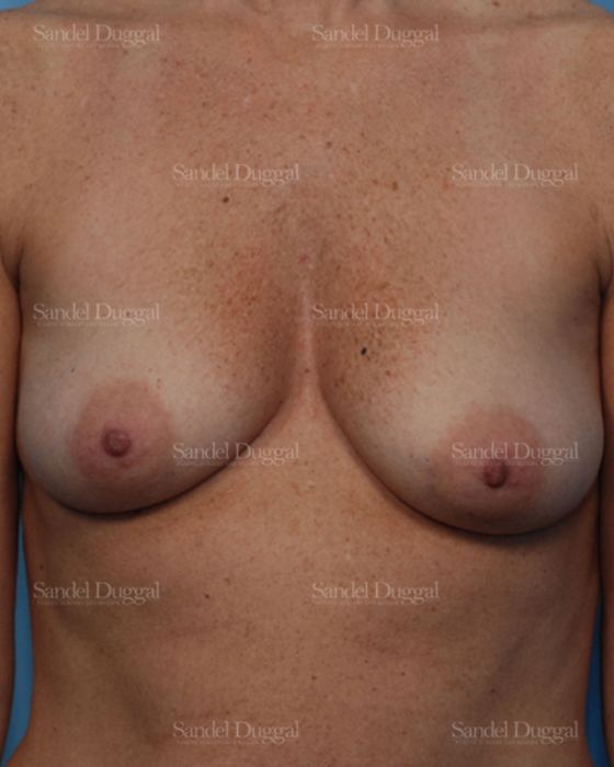 Breast Augmentation with Lift before, case 3435