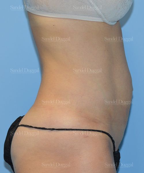 Liposuction — Abdomen after, case 2479