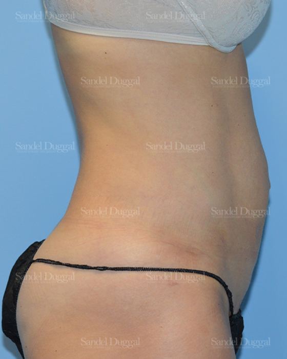 Liposuction — Abdomen after, case 2479