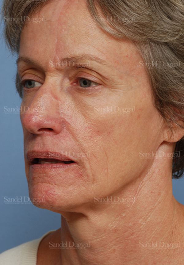 Reconstruction after Mohs after, case 2784