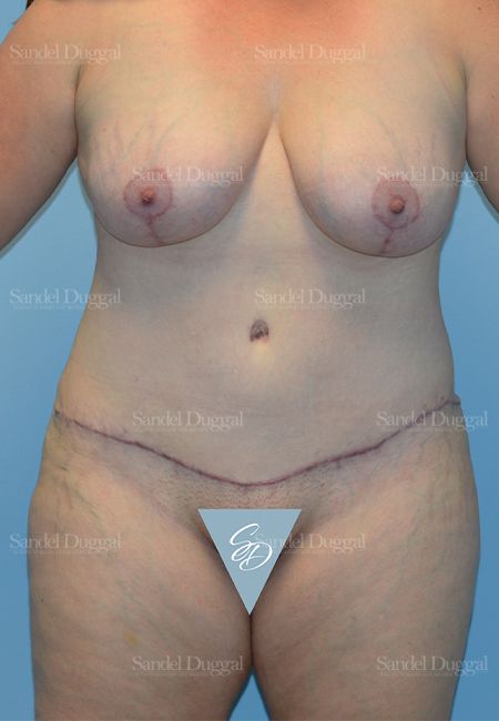 Mommy Makeover after, case 2190