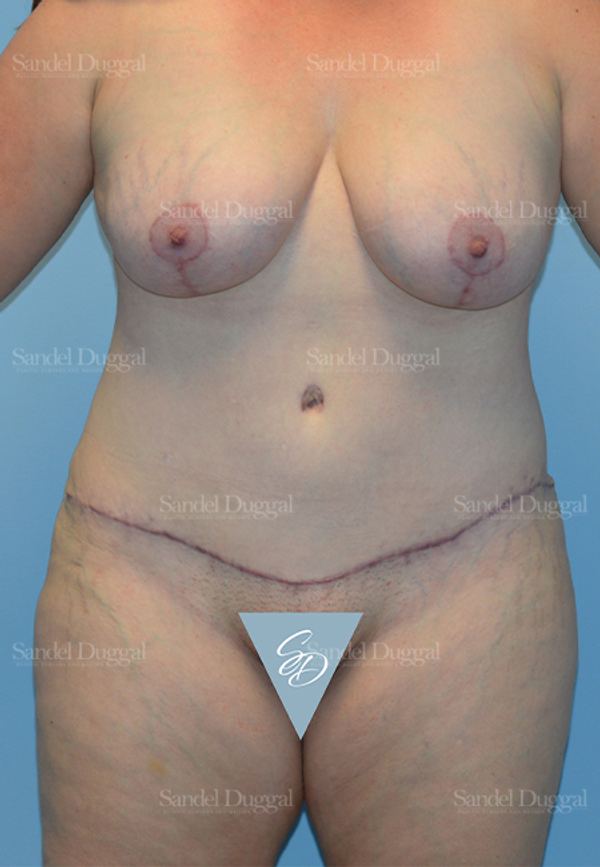 Mommy Makeover after, case 2190
