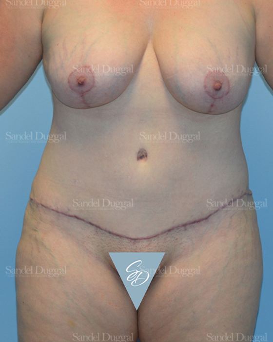Mommy Makeover after, case 2190