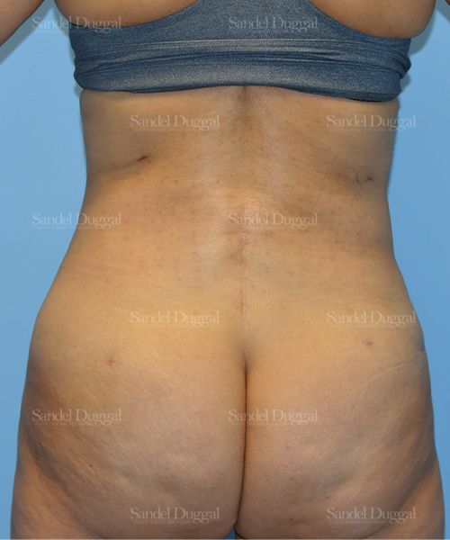 Liposuction — Legs & Flanks after, case 2509