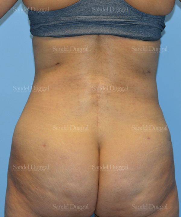 Liposuction — Legs & Flanks after, case 2509