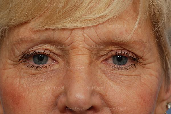Eyelid Rejuvenation before, case 1946
