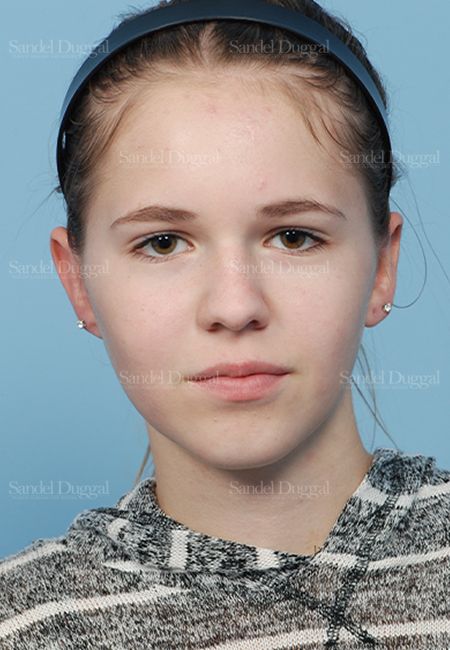 Otoplasty after, case 2598