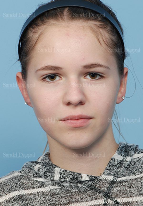 Otoplasty after, case 2598