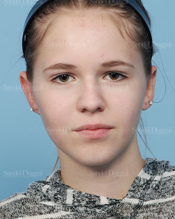 Otoplasty after, case 2598