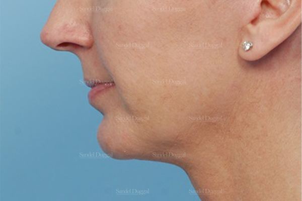 Chin Augmentation after, case 1479