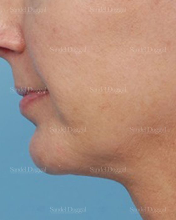 Chin Augmentation after, case 1479