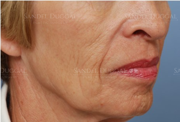 Lower Lip Advancement after