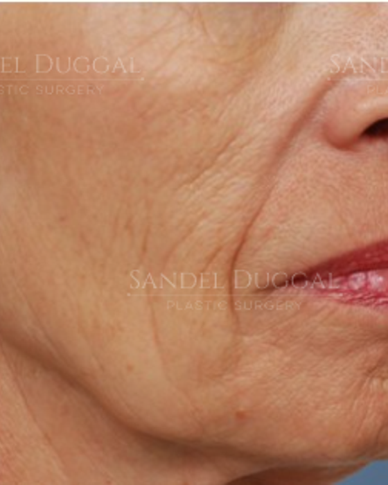 Lower Lip Advancement after, case LLA-2