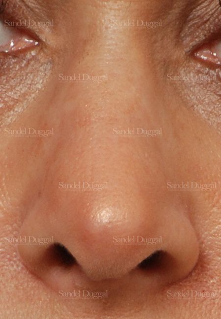 Revision Rhinoplasty after, case 2624