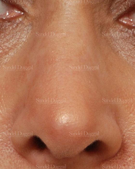 Revision Rhinoplasty after, case 2624