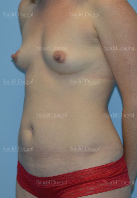 Mommy Makeover before, case 792