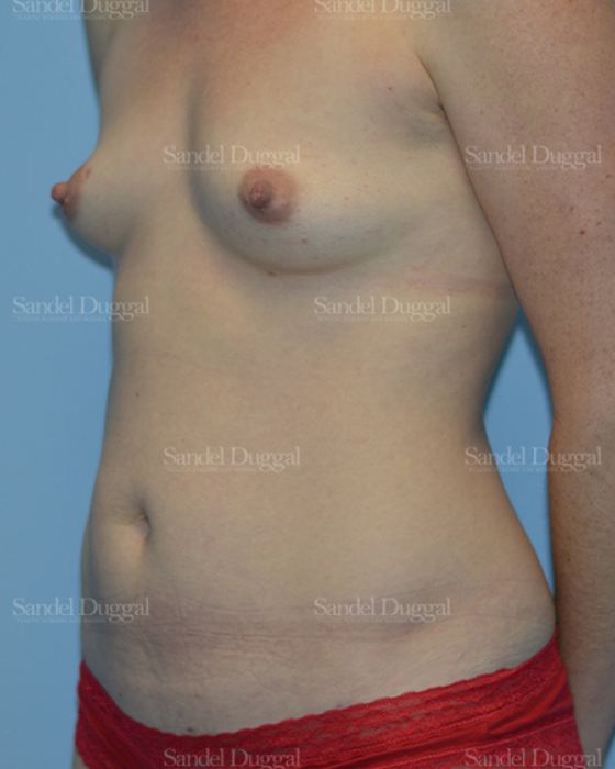 Mommy Makeover before, case 792