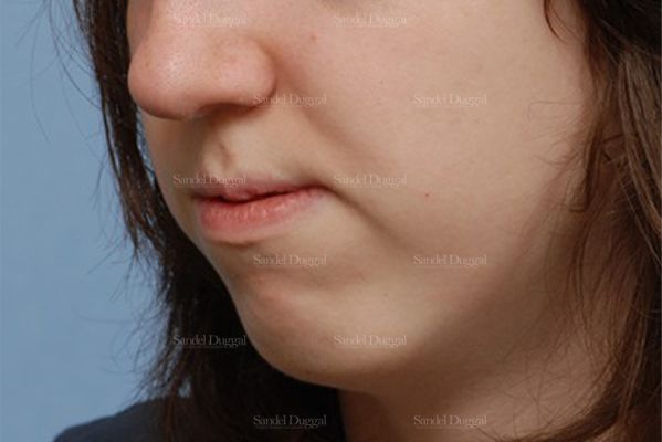 Chin Augmentation before, case 1469