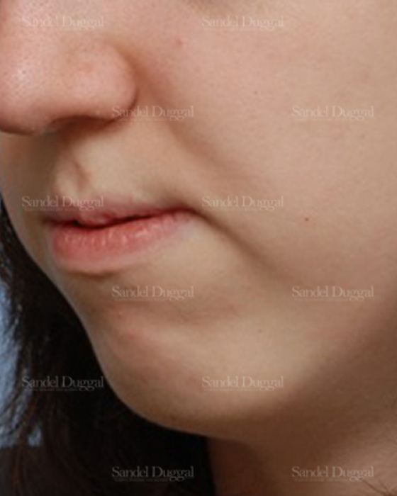Chin Augmentation before, case 1469