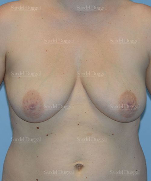 Breast Augmentation with Lift before, case 3428