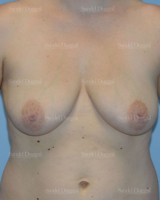 Breast Augmentation with Lift before, case 3428