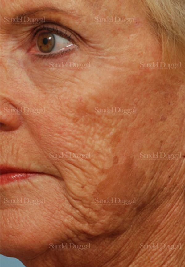 Laser Skin Resurfacing before, case 2963