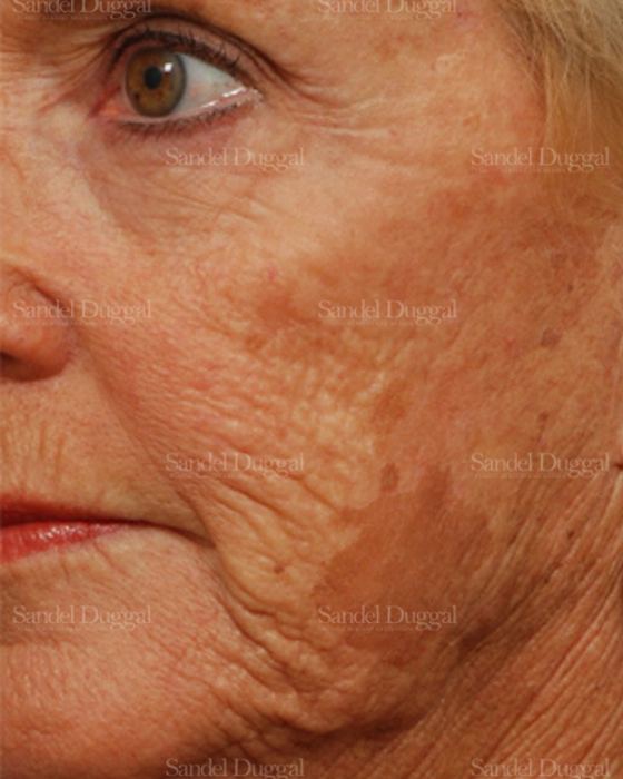 Laser Skin Resurfacing before, case 2963