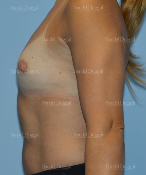 Breast Augmentation before, case 3143