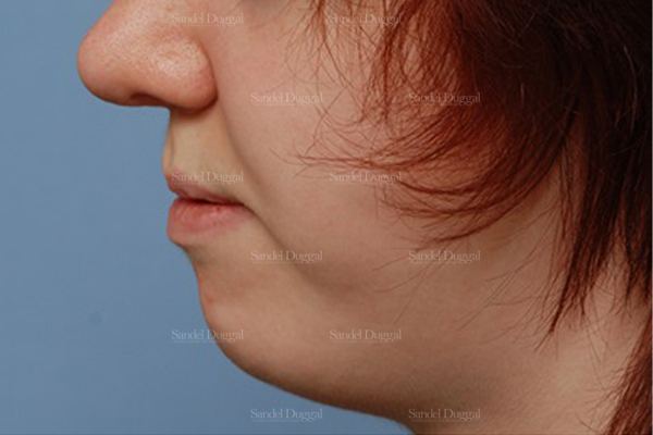 Chin Augmentation after, case 1469