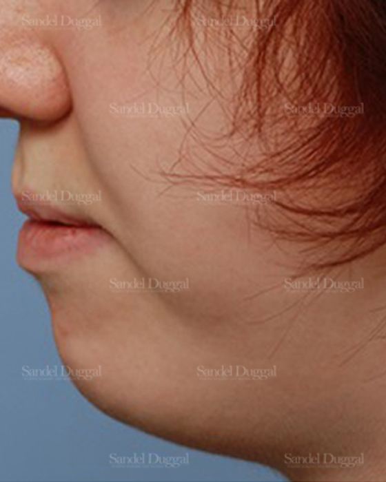 Chin Augmentation after, case 1469