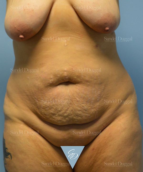 Tummy Tuck before, case 1701