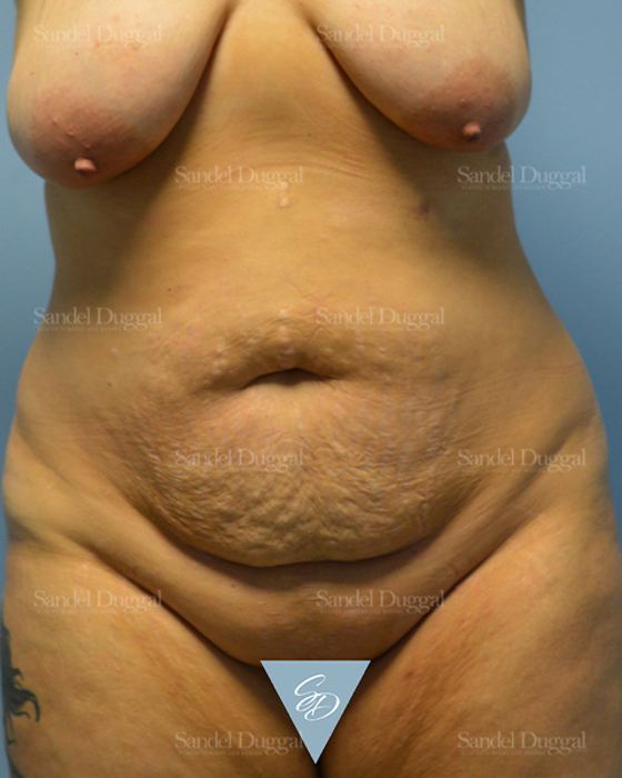 Tummy Tuck before, case 1701