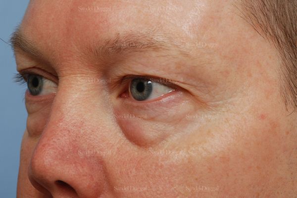 Eyelid Rejuvenation before, case 1965
