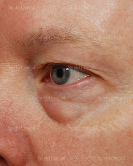 Eyelid Rejuvenation before, case 1965