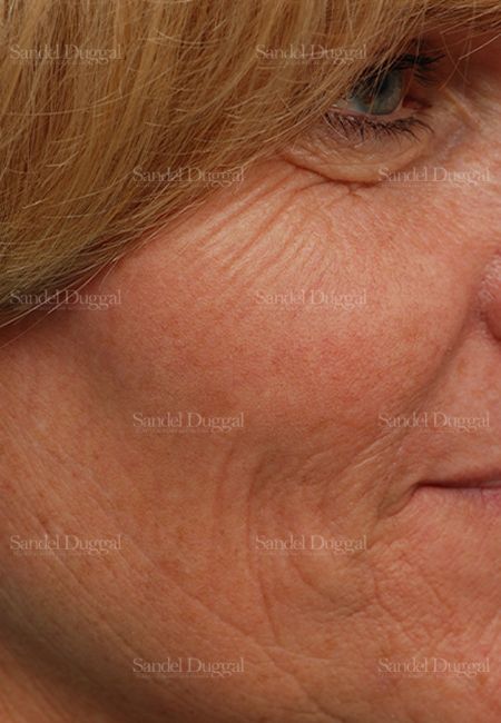 Laser Skin Resurfacing before, case 2955