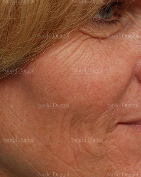 Laser Skin Resurfacing before, case 2955