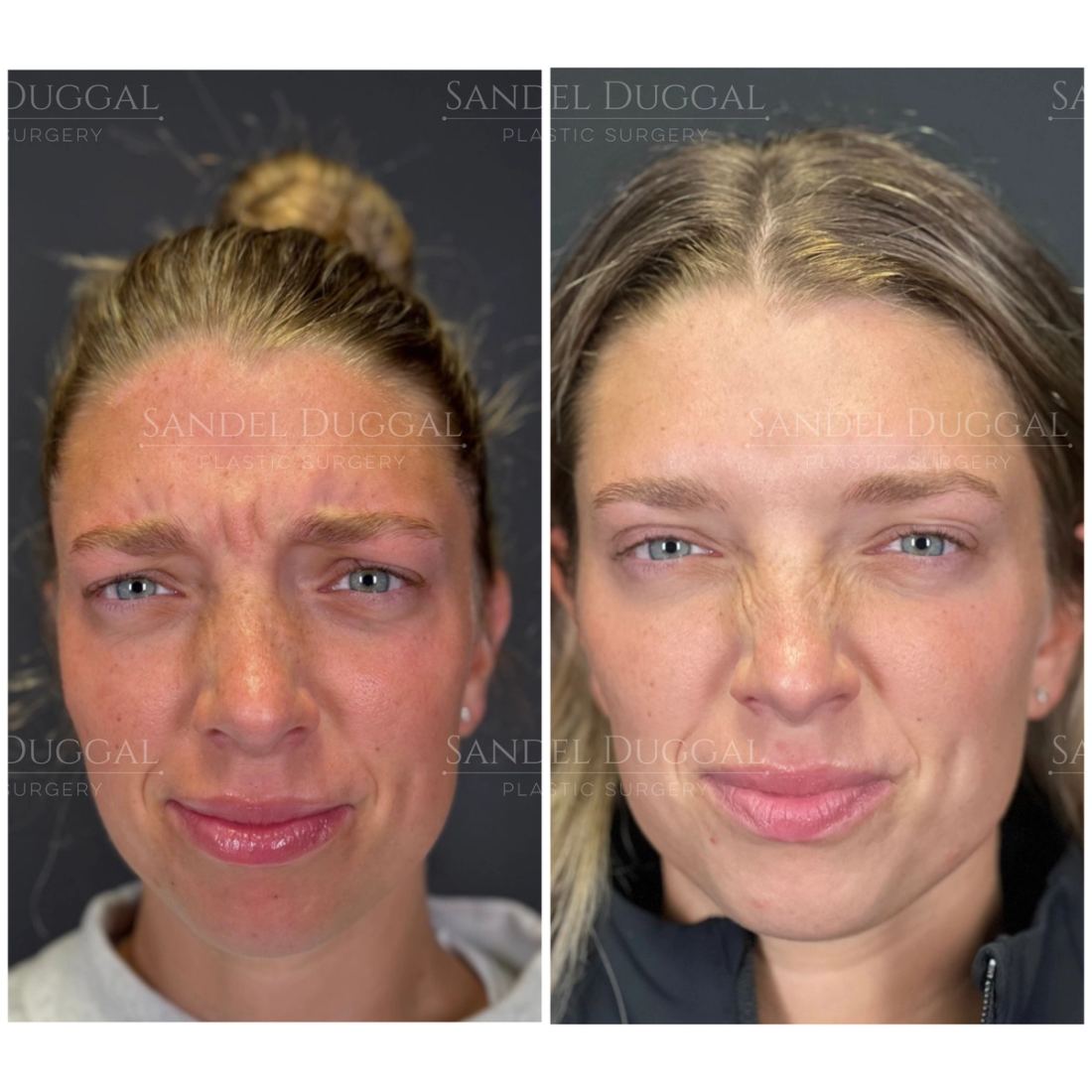Botox & Fillers before and after, case 6009