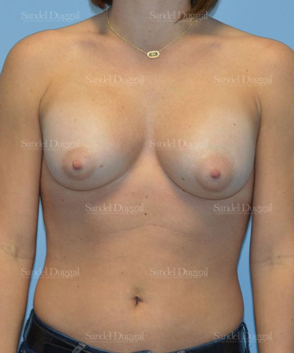 Breast Augmentation after, case 3213