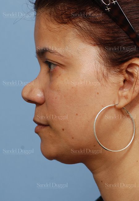 Revision Rhinoplasty before, case 2621