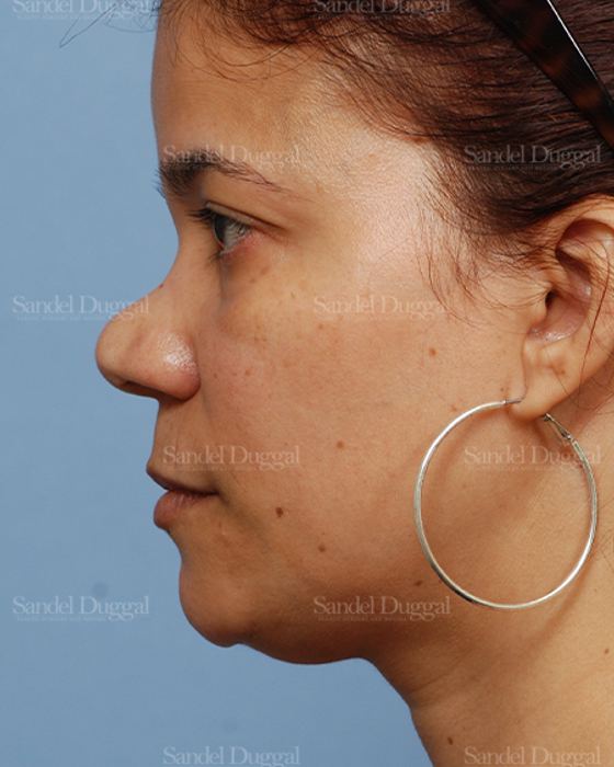 Revision Rhinoplasty before, case 2621
