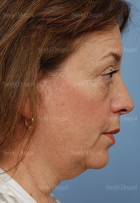 Facelift before, case 813