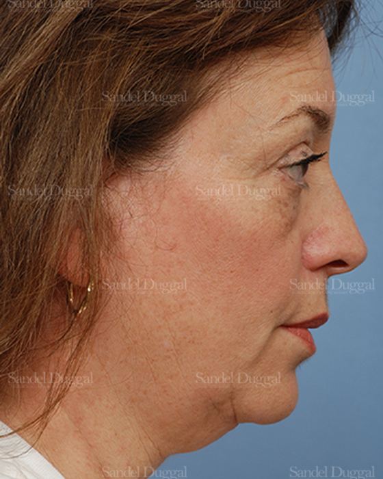 Facelift before, case 813