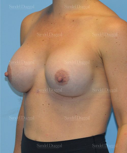 Breast Augmentation after, case 3115