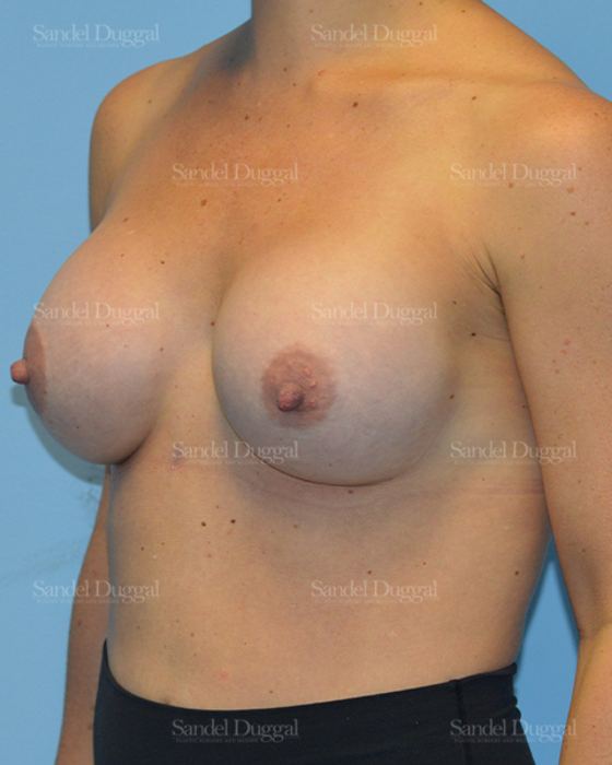 Breast Augmentation after, case 3115