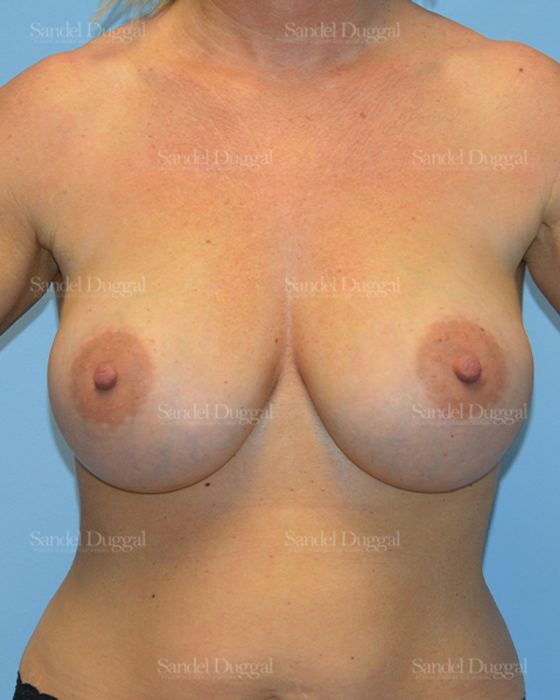Breast Augmentation after, case 3220