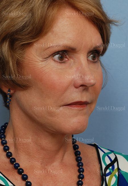 Facelift after, case 2697