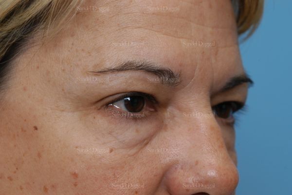 Forehead Lift before, case 2226