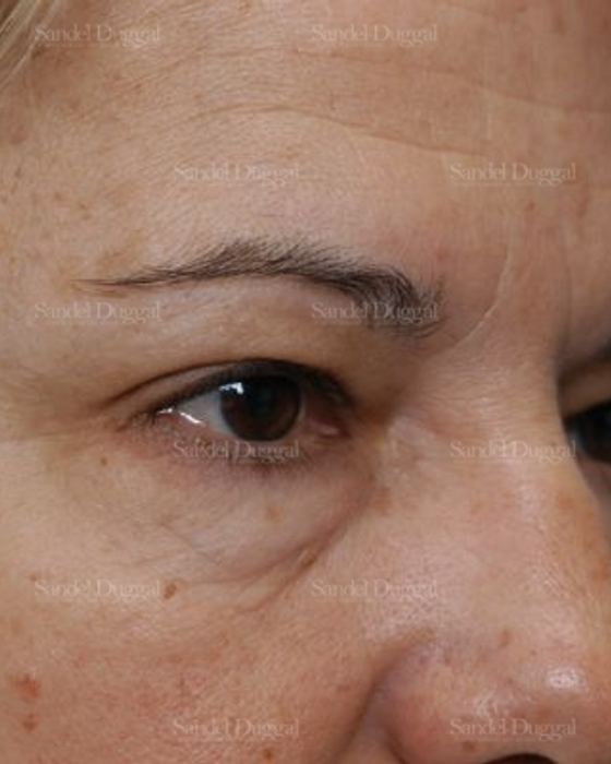 Forehead Lift before, case 2226