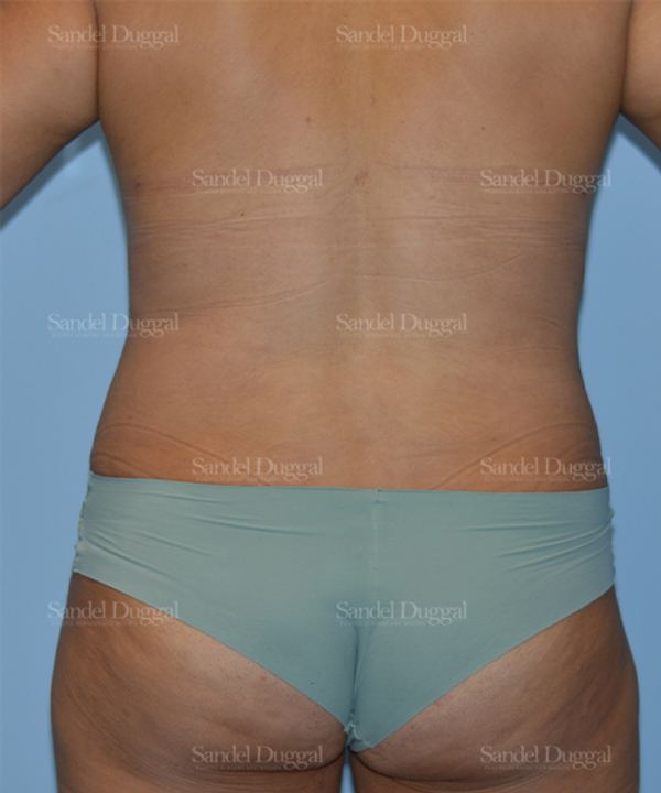 Liposuction — Legs & Flanks after, case 2520